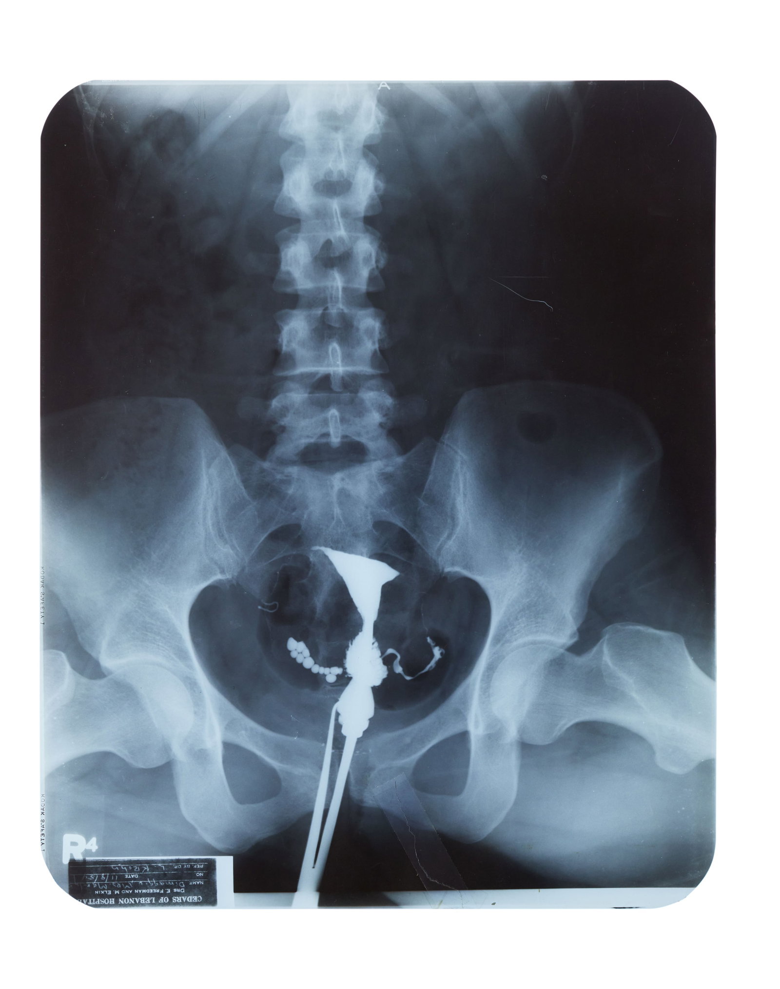 Marilyn Monroe | 1954 Pelvic X-Ray: A standard clear plastic Kodak Safety film; with text in the lower left corner reading in part "Cedars of Lebanon Hospital / Drs. E. Freedman and M. Elkin / Name DiMaggio, Mrs. Marilyn / Date 11/8/54 