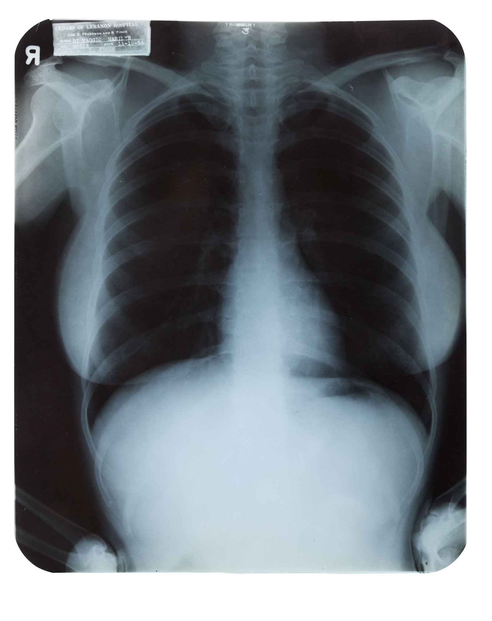 Marilyn Monroe | 1954 Chest X-Ray (1 of 3)