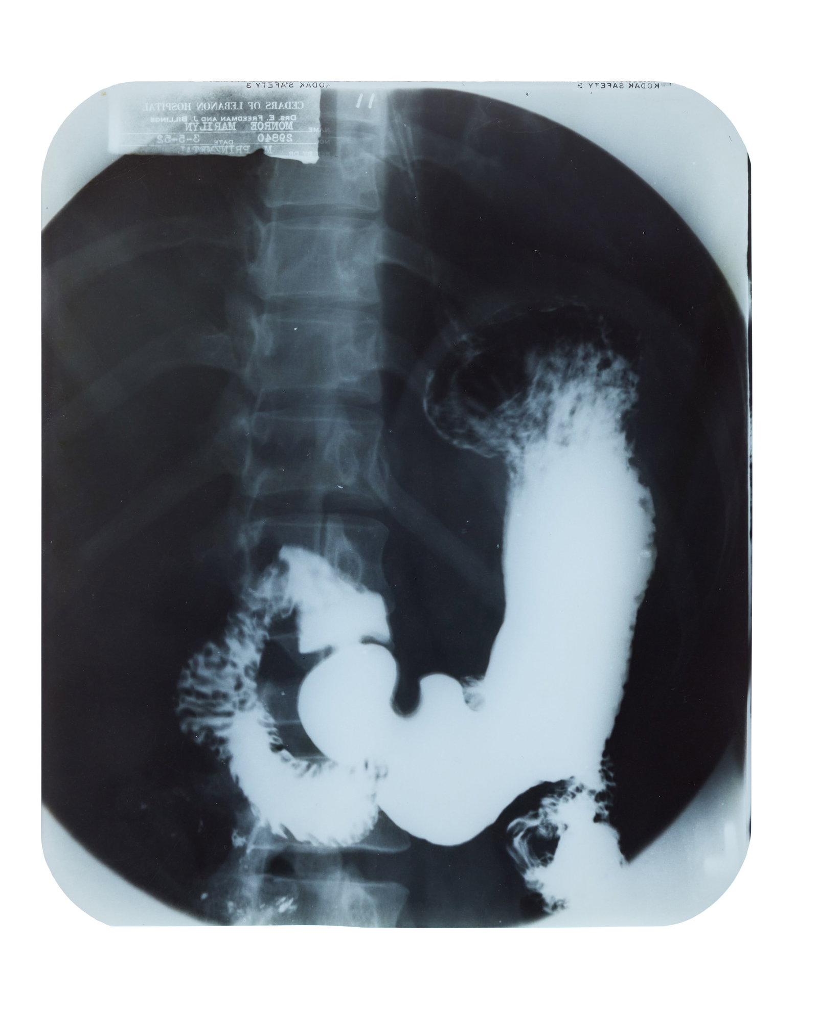 Marilyn Monroe | 1952 Gallbladder X-Ray - 3