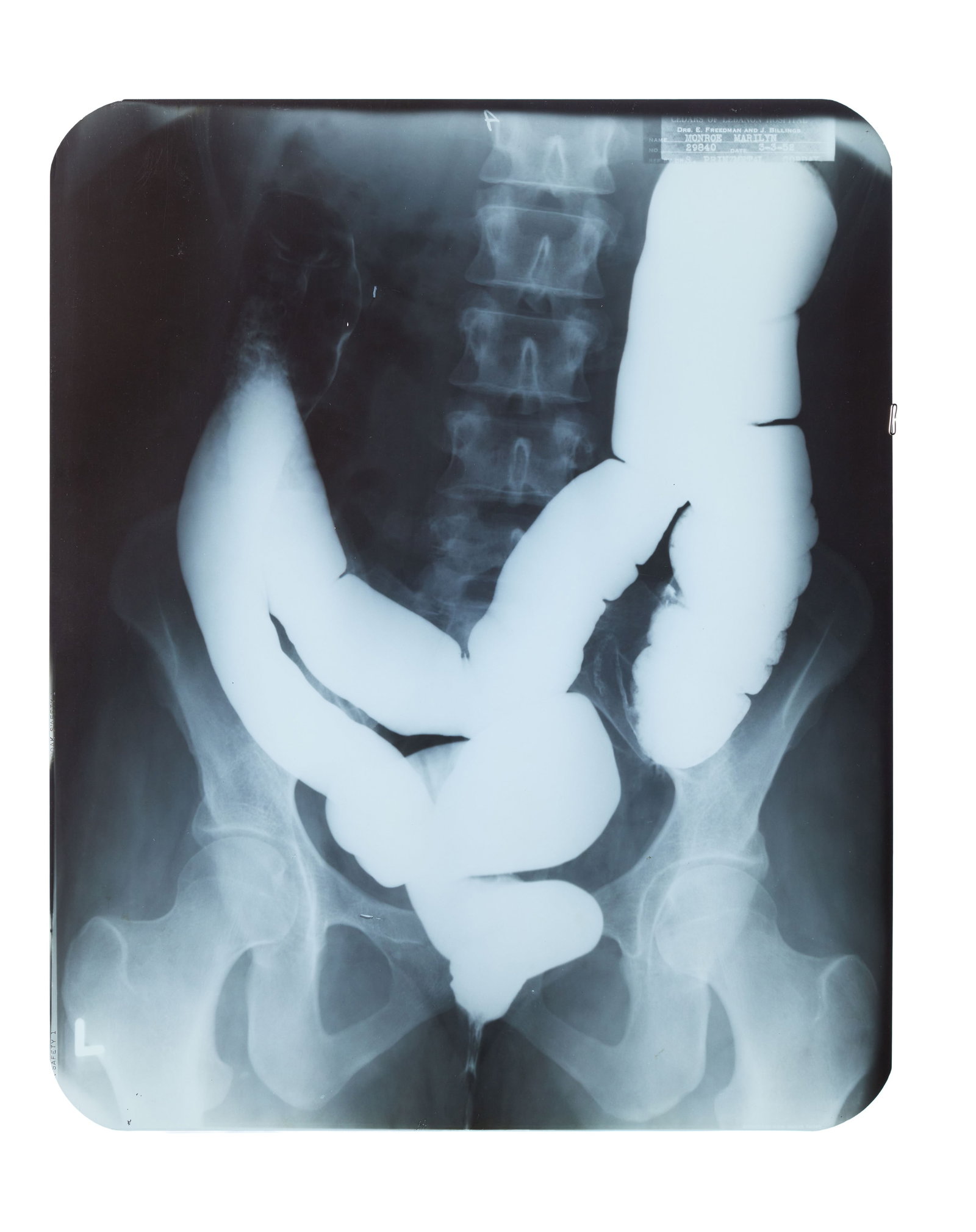 Marilyn Monroe | 1952 Large Intestine X-Ray: A standard clear plastic Kodak Safety film; with text in the upper right corner reading in part "Cedars of Lebanon Hospital / Drs. E. Freedman and J. Billings / Name Marilyn Monroe / Date 3-5-52 /