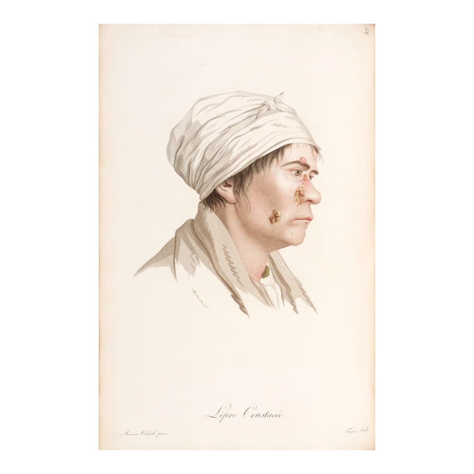 ALIBERT, JEAN-LOUIS. 1768-1837. Description des maladies de la peau observees a l'Hopital Saint-... (1 of 4)