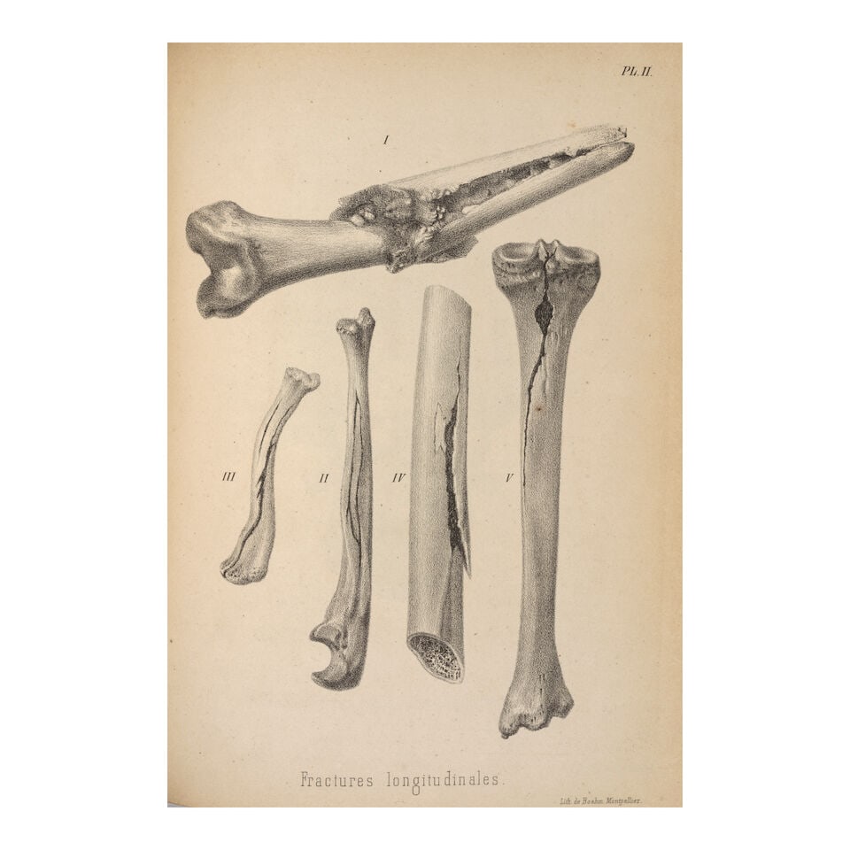 On plastic surgery. Bouisson, Étienne Frédéric (1813-84). Tribut à la chirur... - 2