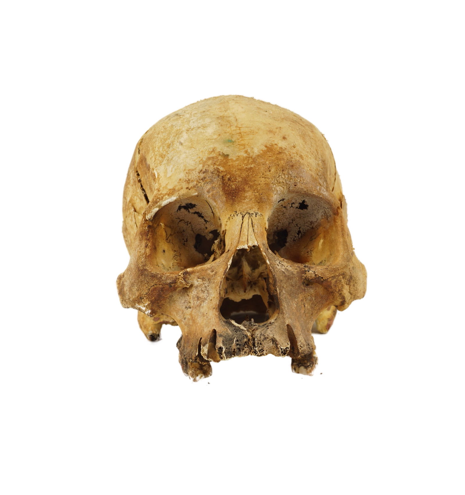 Human Skull: An aged human skull missing a mandible. Has a nice color and look to it. Missing teeth and on the inside of the cranium has some kind of concrete material which actually makes the skull well weighted