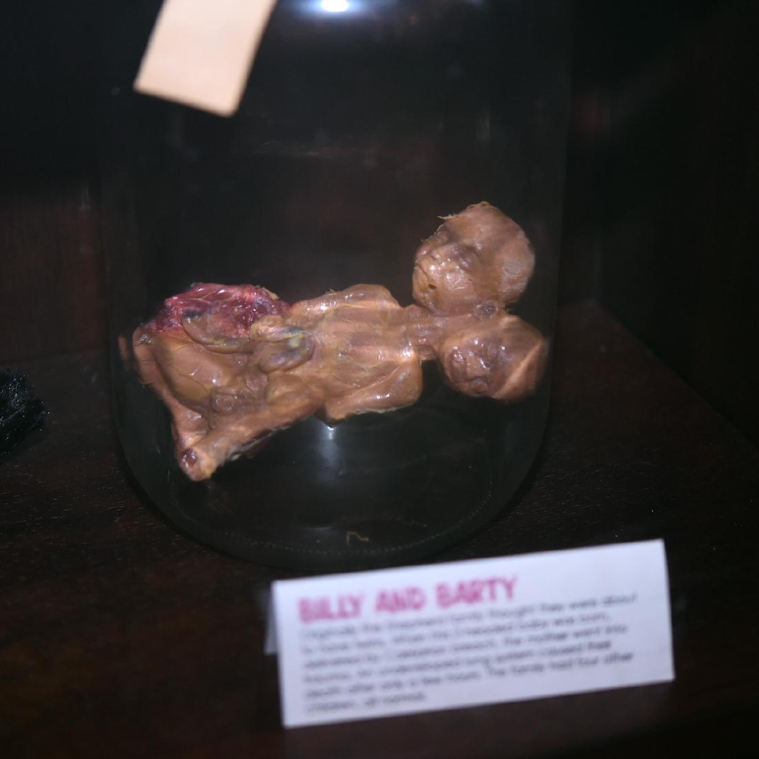 Billy and Barty, The Two Headed Baby (1 of 1)