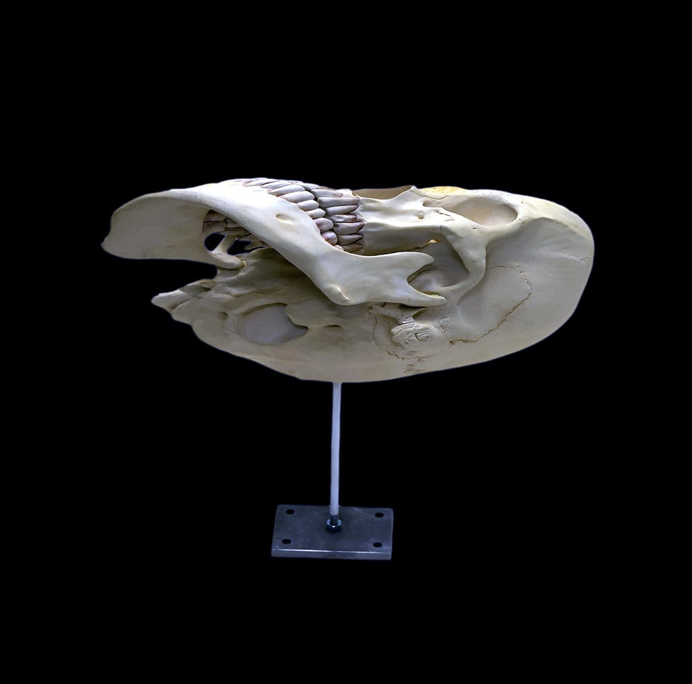 Robert LAZZARINI: "Skull" - Resin, Bone, Pigment: Robert Lazzarini (American, b. 1965) resin, bone, and pigment sculpture of an amorphic skull, reminiscent of that in Hans Holbein's The Ambassadors, titled "Skull," 2000. With metal plate for wall mou