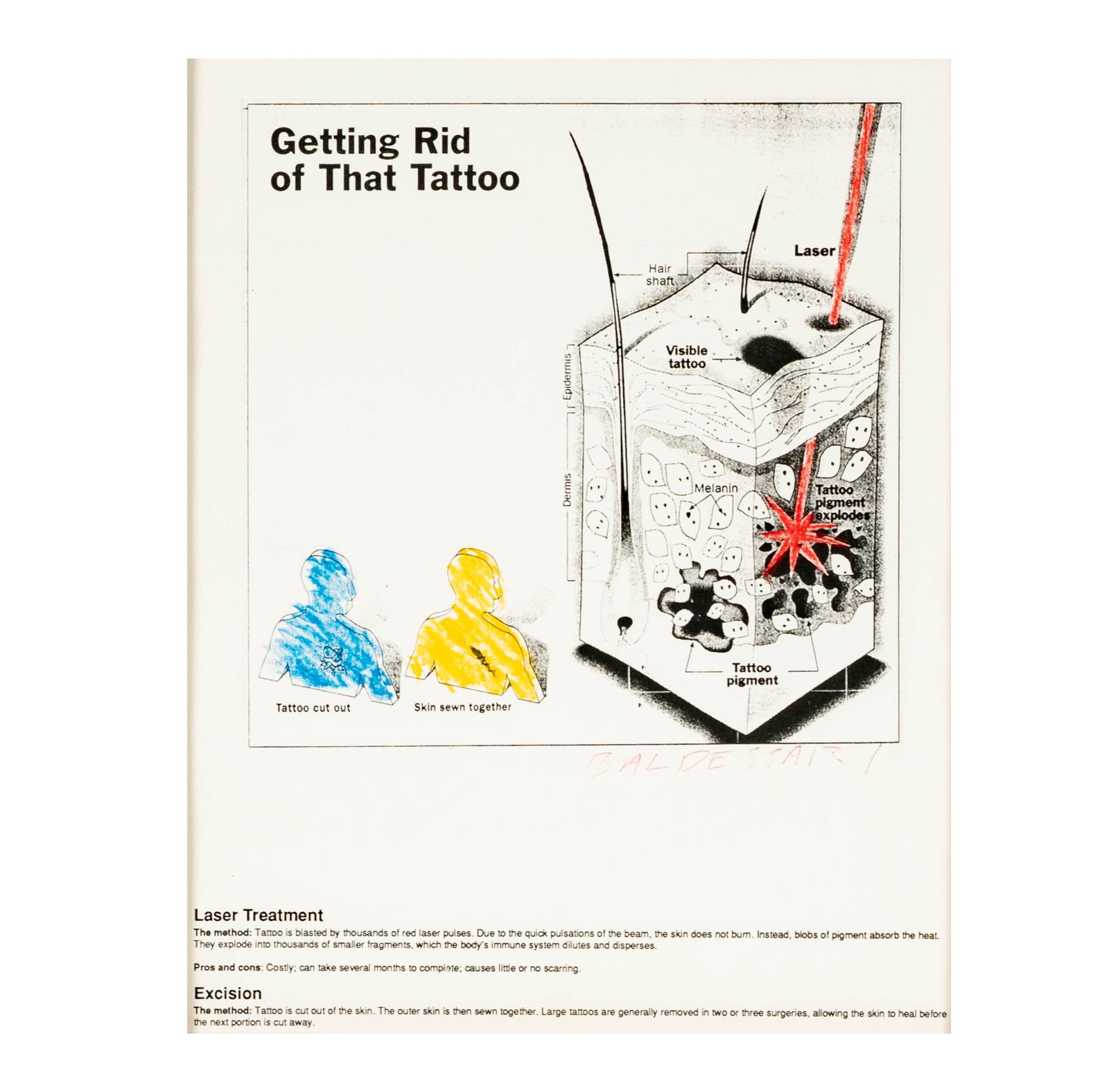 John Baldessari (American, 1931-2020), Tattoo Removal (1 of 8)