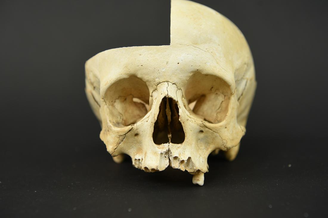 EARLY 20TH C. SKULL WITH/ SAGITTAL CUT (1 of 20)