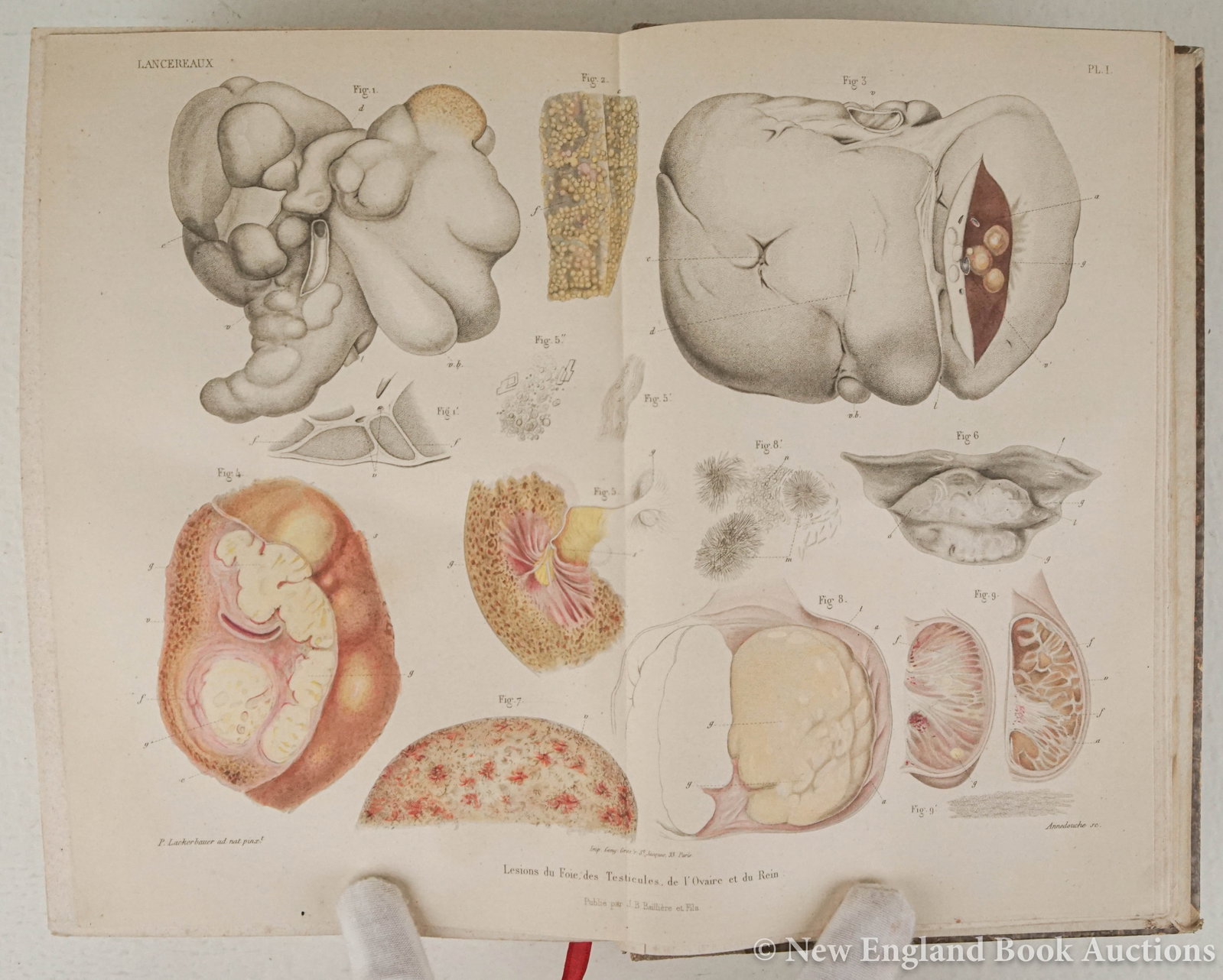 Syphilis - 11
