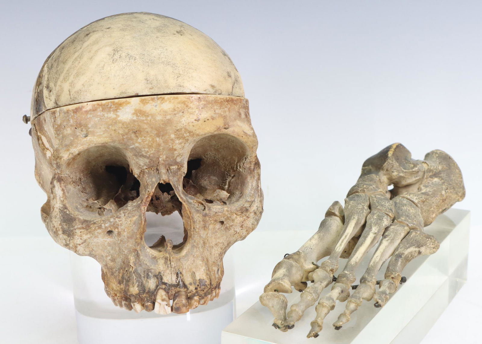Human Skull and Bones Medical Specimens: Antique medical skull excluding mandible, 5.5"h x 5"w x 7"d, and foot and ankle bones, 8.5" x 3".
