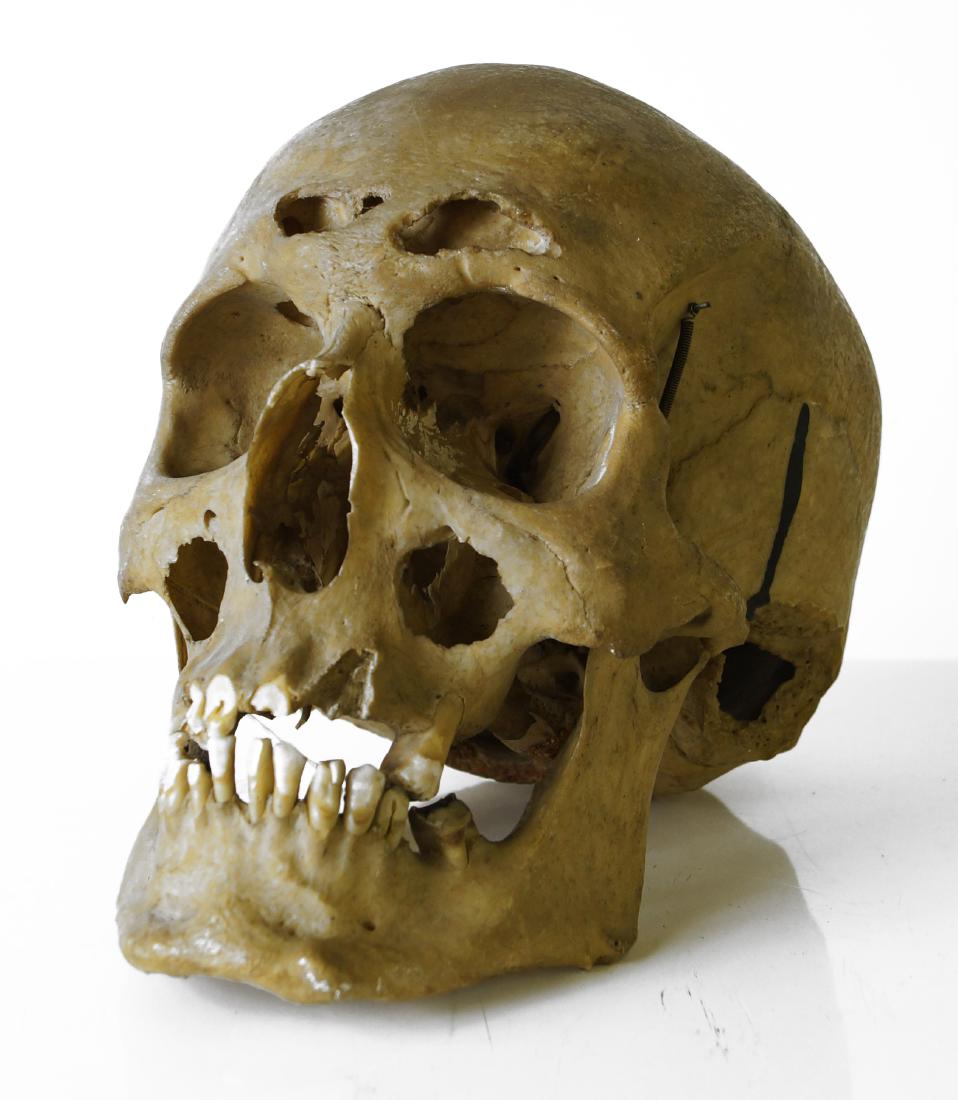 HUMAN SKULL FOR MEDICAL STUDY WITH DISEASE (1 of 4)