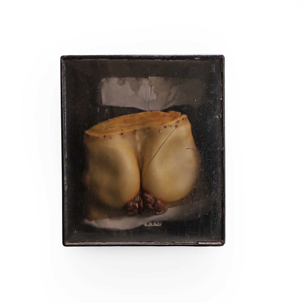 A cased wax medical diorama, late 19th to early 20th century,: A cased wax medical diorama, late 19th to early 20th century, modelled syphilitic haemorrhoids, wax, cased (case 41.5cm wide, 19.2cm deep, 48.8cm high) Footnote: 'I always thought this might be shocki
