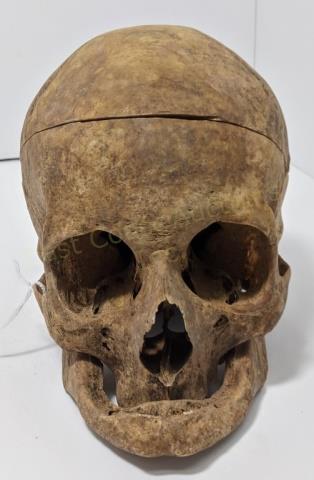 Vintage Medical Skull With Jaw Detached: The (real) human skull in somewhat rough condition. With detachable cranium. Jaw present but not wired. No teeth. Appx. 9" deep and 6.5" tall.