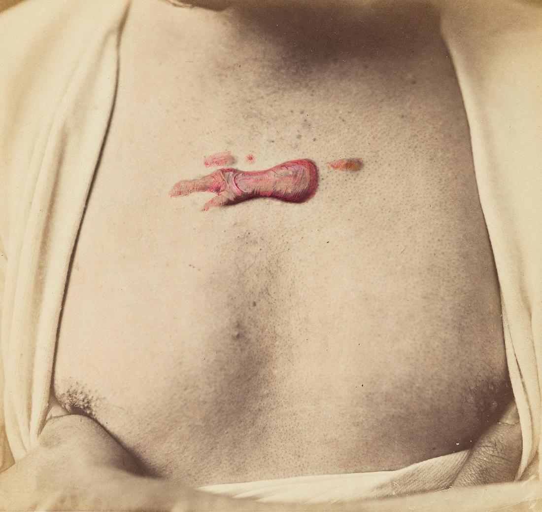 HIPPOLYTE MORESTIN (1869-1919) A medical documentary: HIPPOLYTE MORESTIN (1869-1919) A medical documentary photograph depicting a man's chest with a scar, with applied hand-coloring. Hand-tinted albumen print, the image measuring 6¼ inches (15.9 cm.