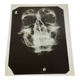 AN X-RAY OF ADOLF HITLER'S SKULL