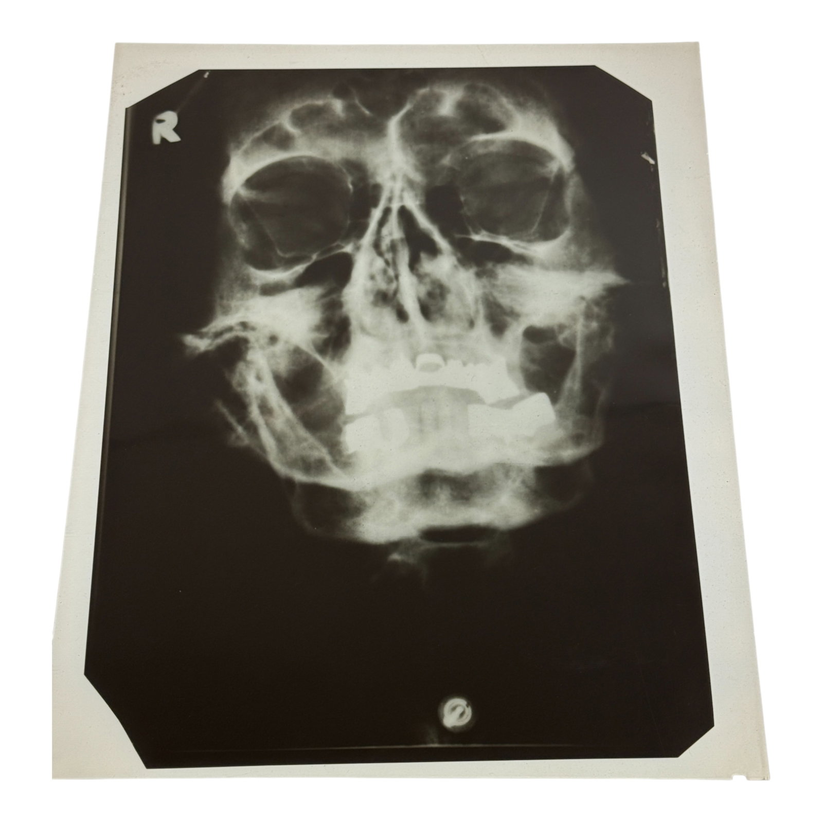 AN X-RAY OF ADOLF HITLER'S SKULL: A x-ray of Adolf Hitler's skull on photographic fil, 8" x 10", showing nearly the entire skull. This image was once part of classified printed report issued by the U.S. Military Intelligence Service C