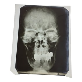 AN X-RAY OF ADOLF HITLER'S SKULL