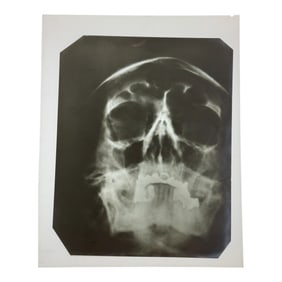 AN X-RAY OF ADOLF HITLER'S SKULL