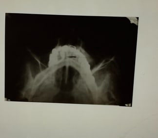 AN X-RAY OF ADOLF HITLER'S SKULL