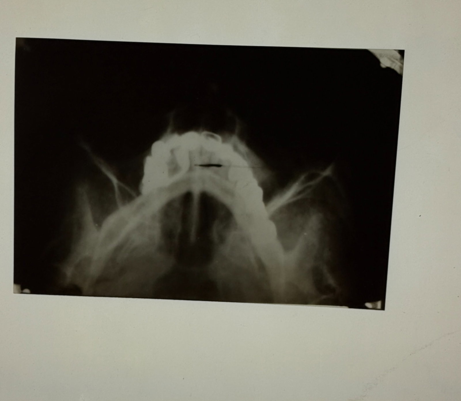 AN X-RAY OF ADOLF HITLER'S SKULL: A x-ray of Adolf Hitler's skull on photographic fil, 8" x 10", showing nearly the entire skull. This image was once part of classified printed report issued by the U.S. Military Intelligence Service C