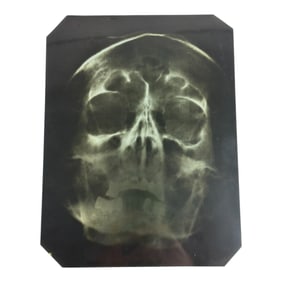 AN X-RAY OF ADOLF HITLER'S SKULL