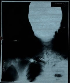 Michael jackson XRAY