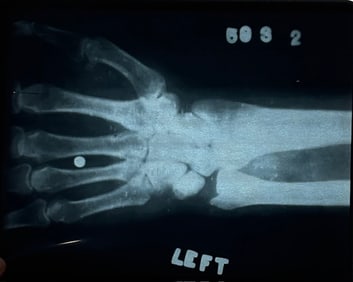 Harry Houdini XRAY
