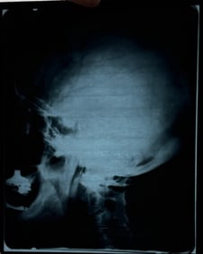 Albert Einstein XRAY of his brain !