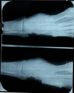 Elvis Presley XRAY: An Xray from the King of Rock N Roll who fractured a leg in a horse riding accident Certificate of AuthenticityEVERY item in this auction comes with at minimum a full illustrated serial numbered COA s