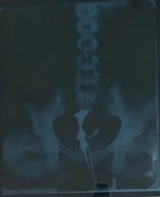 Marilyn Monroe original Xray of pelvic region