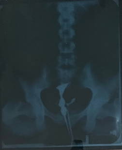 Marilyn Monroe original Xray of pelvic region: "A rare one of six found actual Xray of Marilyn Mon Certificate of AuthenticityEVERY item in this auction comes with at minimum a full illustrated serial numbered COA signed by the worlds leading