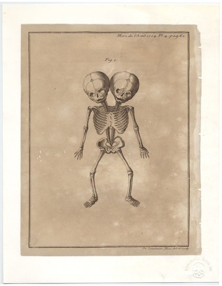 TWO-HEADED BABY ANOMALY freak print (1 of 1)