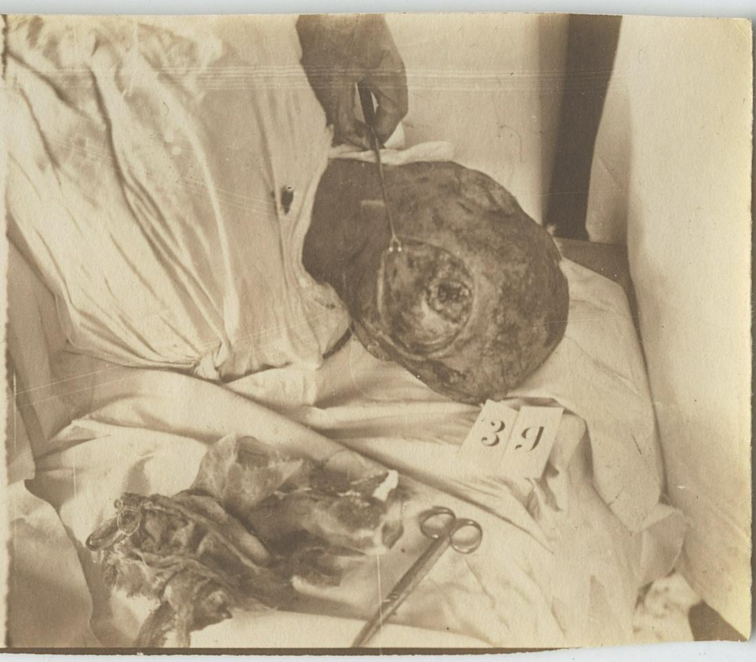 Authentic Archive French Surgical Photograph WWI (1 of 2)