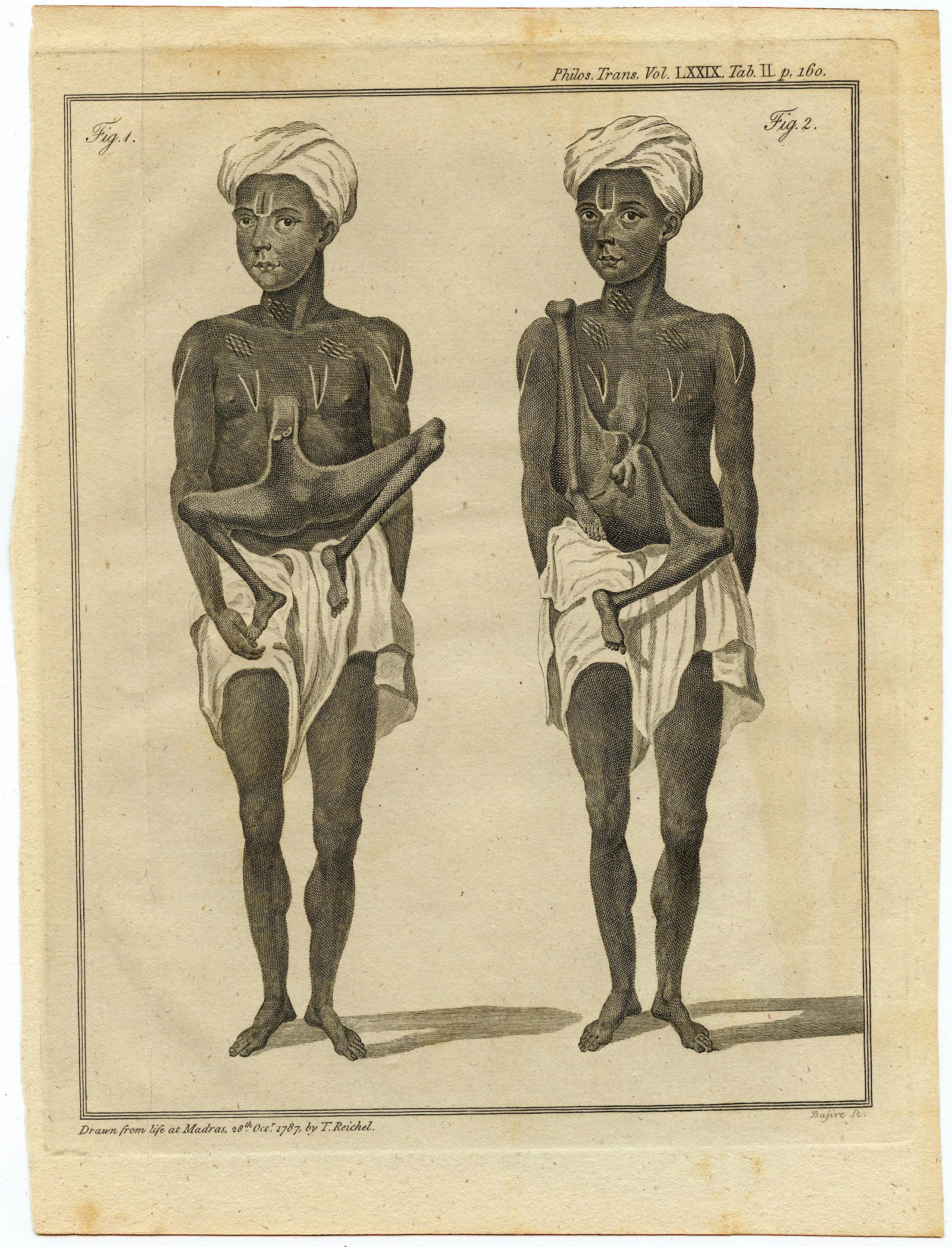 Very Rare Physical Deformities Medical Print 18th C. (1 of 1)