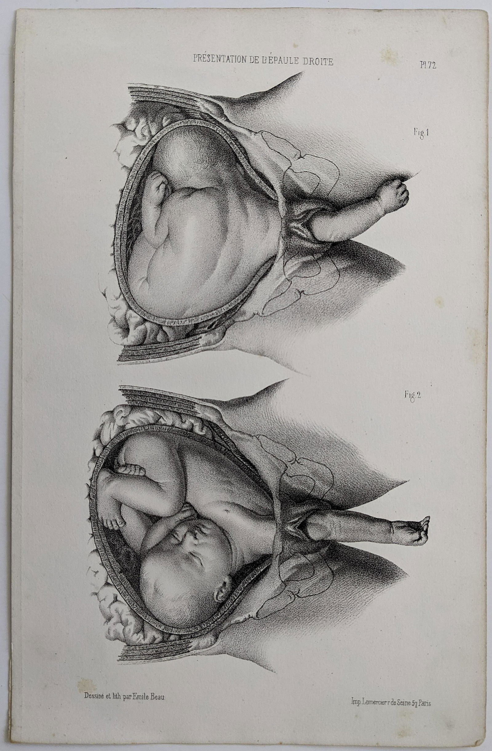 Scarce Antique Medical Litho. Print, 19th C. (1 of 2)