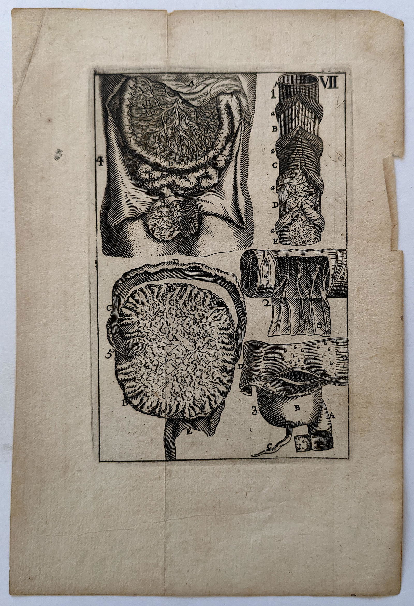 Very Rare Antique Medical Anatomy Etching Print 18th C. (1 of 1)