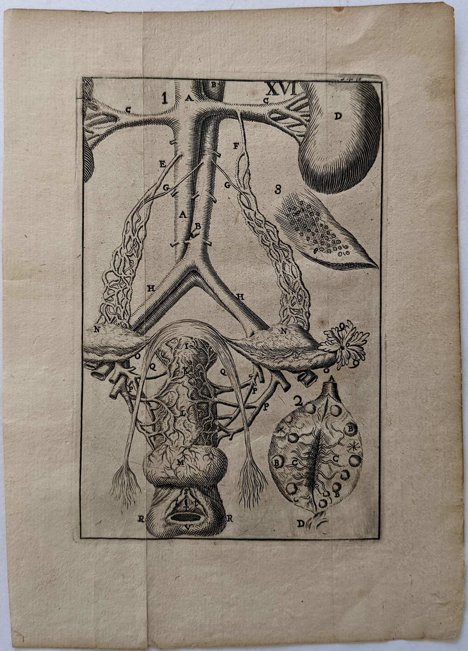 Very Rare Antique Medical Anatomy Etching Print 18th C. (1 of 1)
