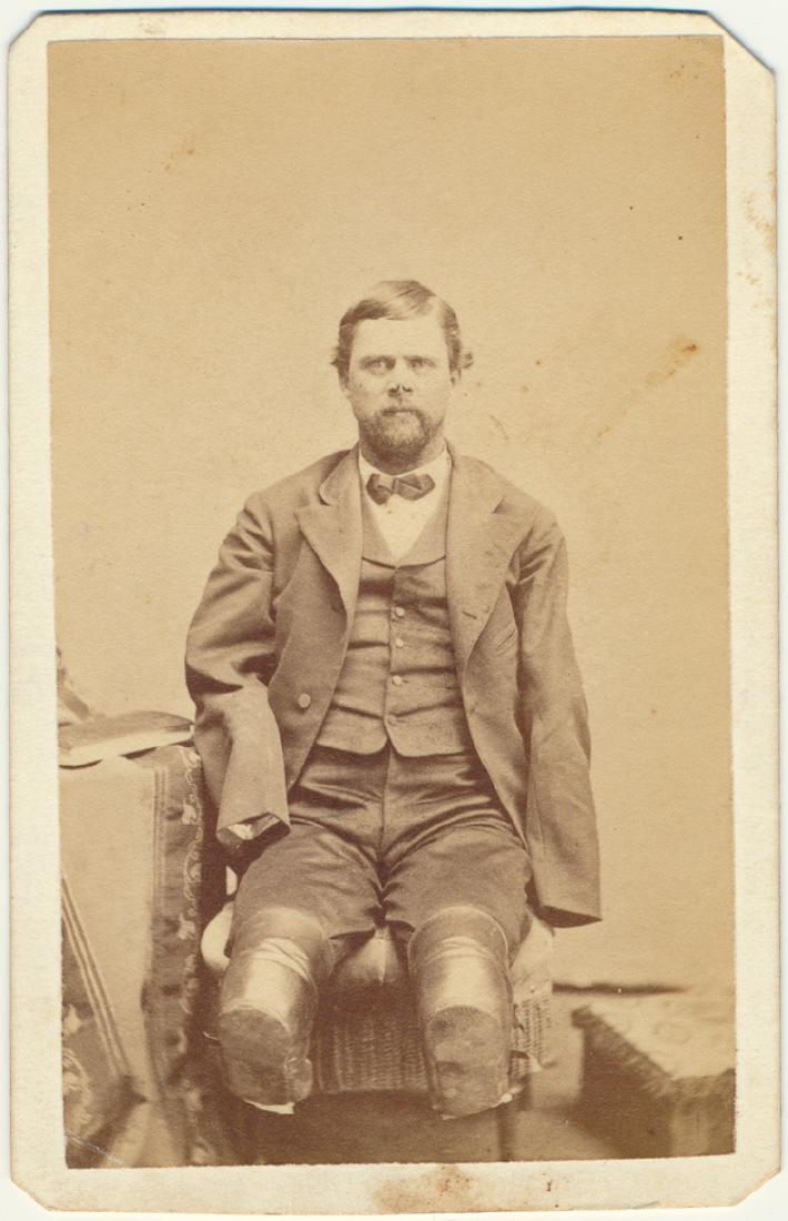 CAVALRYMAN AND FROSTBITE VICTIM: CAVALRYMAN AND FROSTBITE VICTIM Carte de visite photo of soldier Benjamin Franklin who, with four others, was caught in a storm while travelling between Fort Wadsworth, D.T and Fort Ridgeley, Mn. Whil