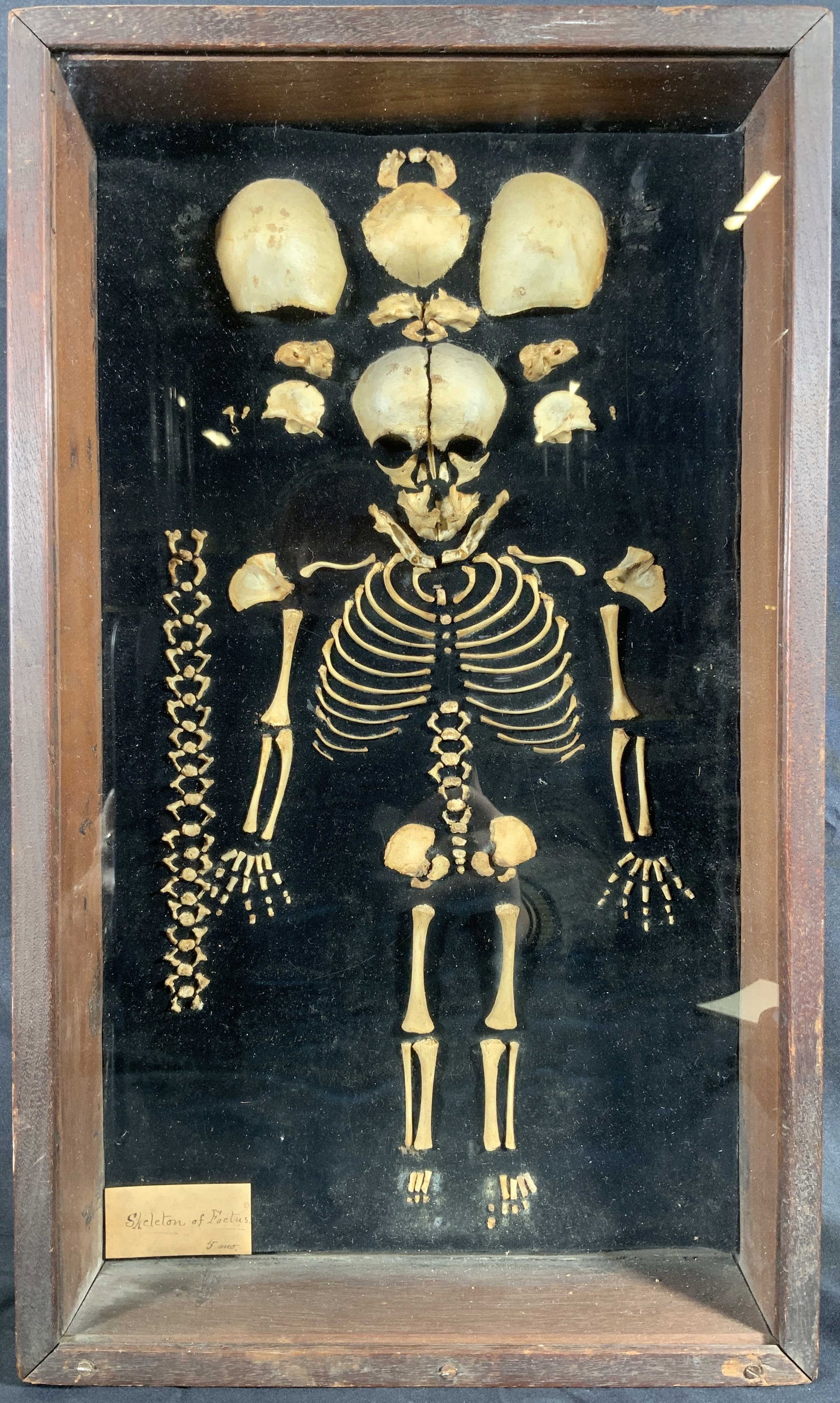 Shadow Box 5 Month Fetus Skeletal Display: 5 Month Fetus Skeleton display. Pinned on velvet cushion. Paper in lower left corner reads Skeleton of Fetus, 5 Months. Skeleton is missing some pieces or bones. Frame in brown wooden shadow box. Shad