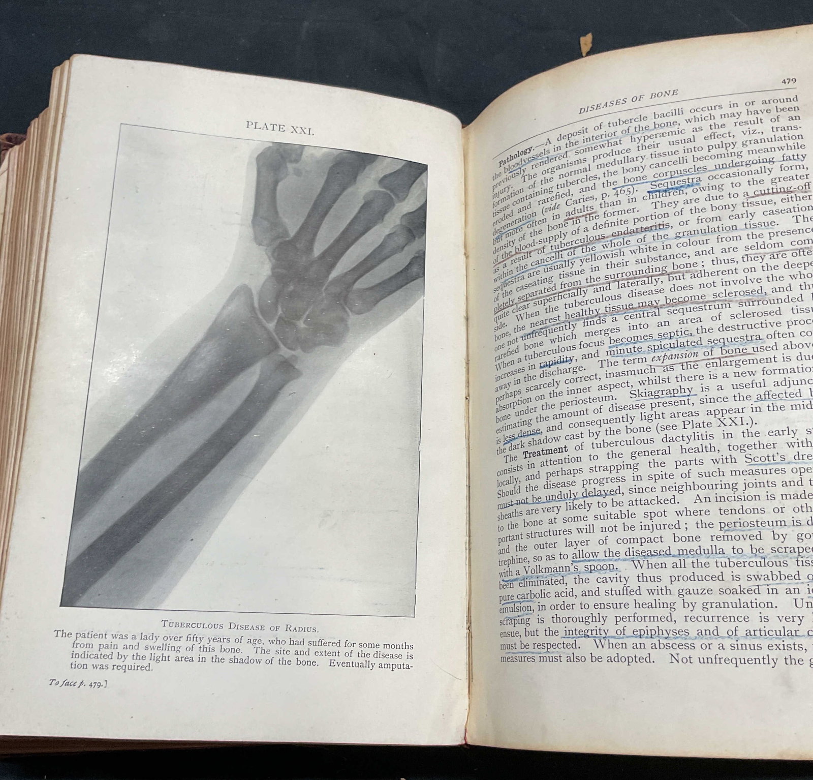 1900 Manual of Surgery, Rose & Carless, Illustr: Antique hardcover copy of A Manual of Surgery by William Rose and Albert Carless. Published by Bailliere, Tindall, and Cox, 1900. Third edition. Contains illustrations. Measures approx. 8.5 x 6 inches