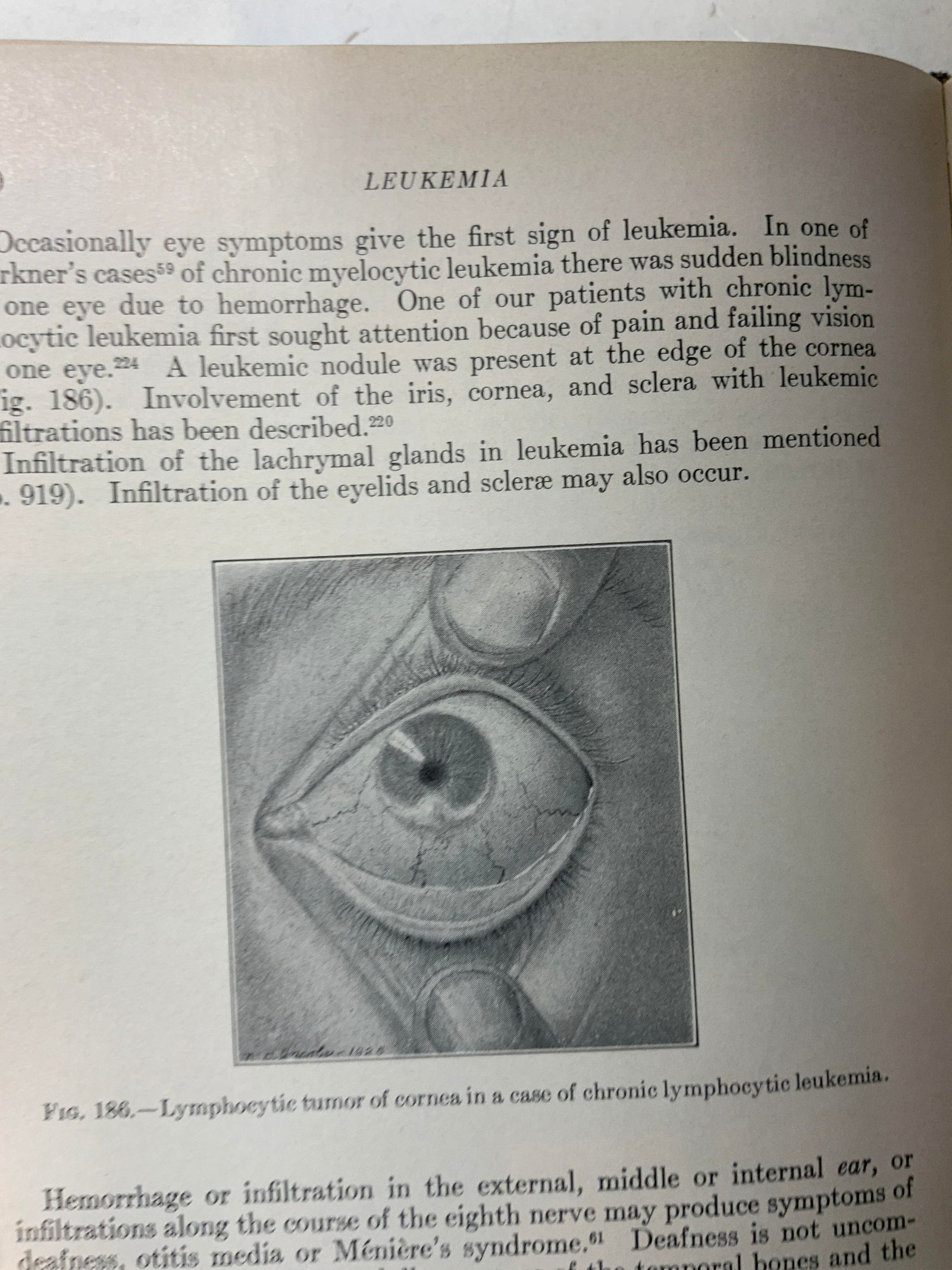 1956 Clinical Hematology 4thEd Book WINTROBE Illst (1 of 11)
