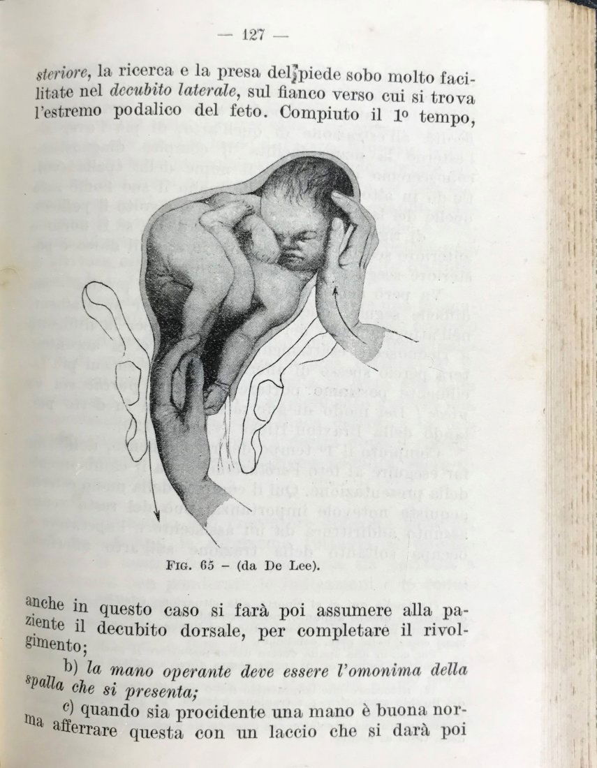 Obstetrics. Lot of 4 works: GAIFAMI, Paolo. Prontuario di Terapia Ostetrica. Roma, L. Pozzi, 192616mo, 154x113 mm, legatura in Tela. Bell’esemplareUnito con/Bound with: VELPEAU, Alphonse. Trattato Completo di Ostetricia o Toco