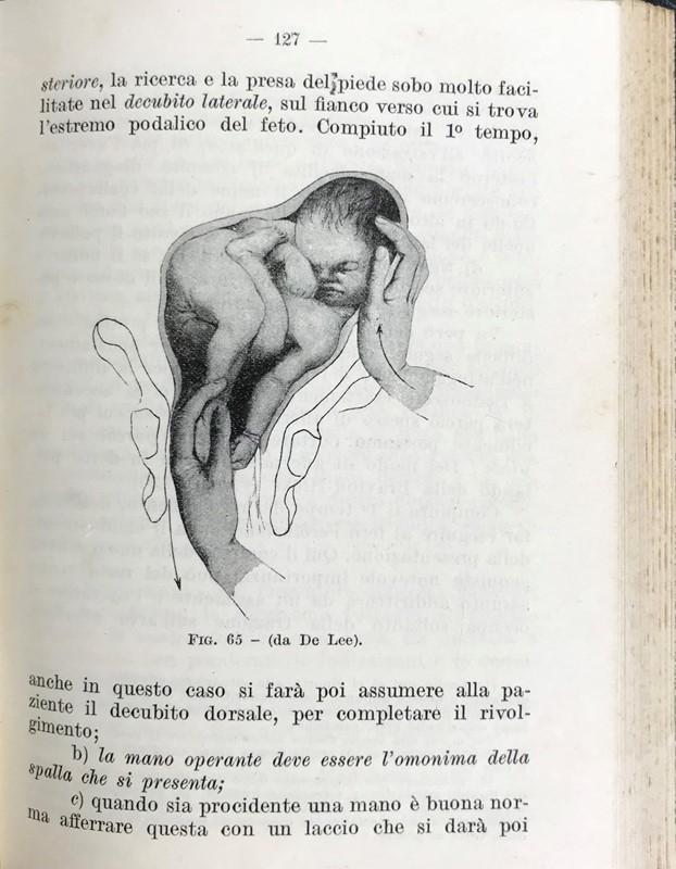 Obstetrics. Lot of 4 works.: GAIFAMI, Paolo. Prontuario di Terapia Ostetrica. Roma, L. Pozzi, 1926 16mo, 154x113 mm, legatura in Tela. Bell'esemplare. Unito con/Bound with: VELPEAU, Alphonse. Trattato Completo di Ostetricia o Toc