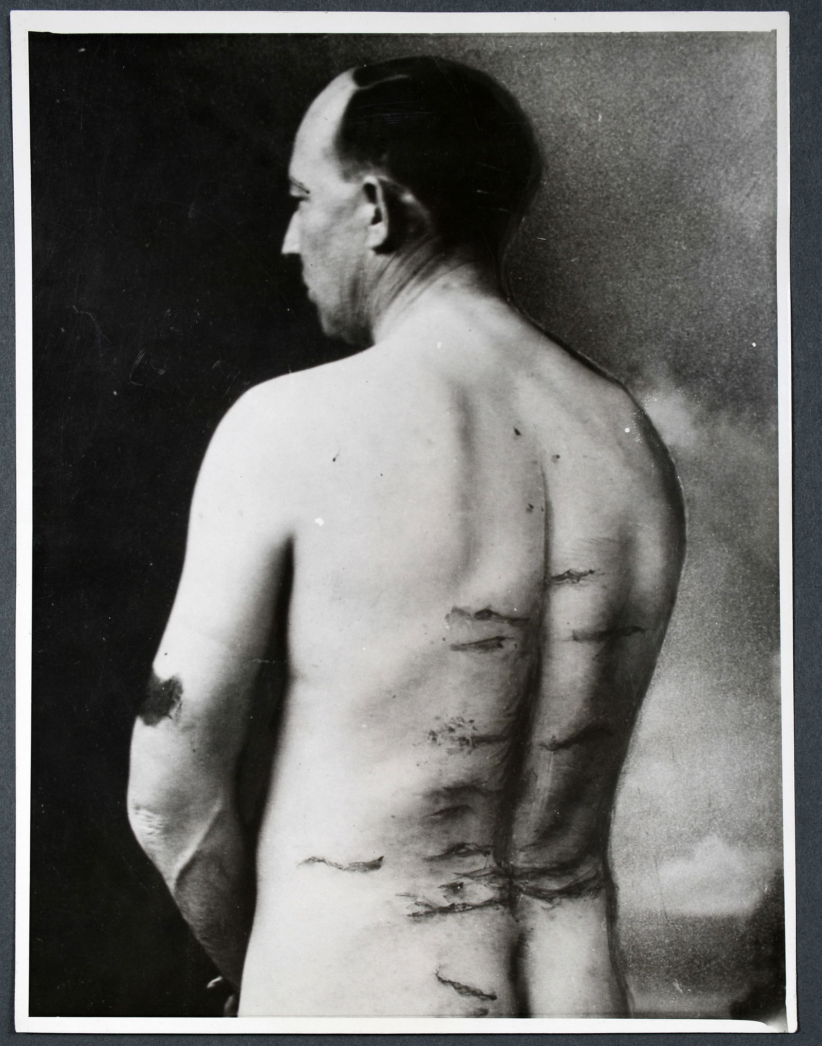 Press Photo. John G. Pyles Showing Welts On Back Inflicted During Beating By Ku Klux Klansman.: Press Photo. John G. Pyles Showing Welts On Back Inflicted During Beating By Ku Klux Klansman. 1922. Black and white photograph. Excellent condition. 6.5" w x 8.5" h. Provenance: The Richard Harris Af