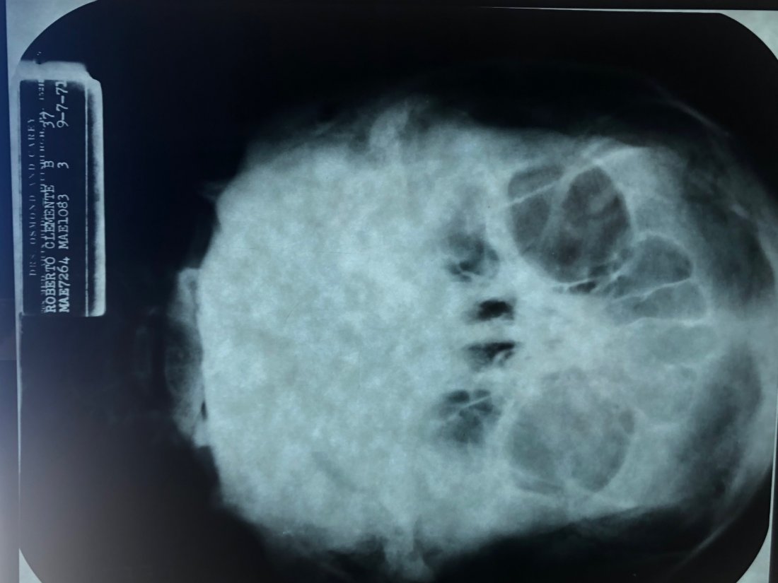 Roberto Clemente- X-Ray of his Head (1 of 2)