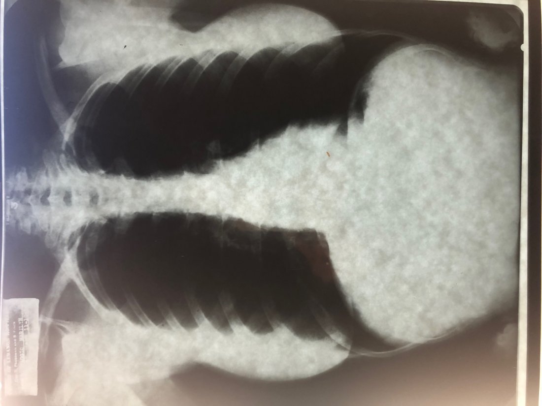 Marilyn Monroe-X-Ray of Her Chest (1 of 2)