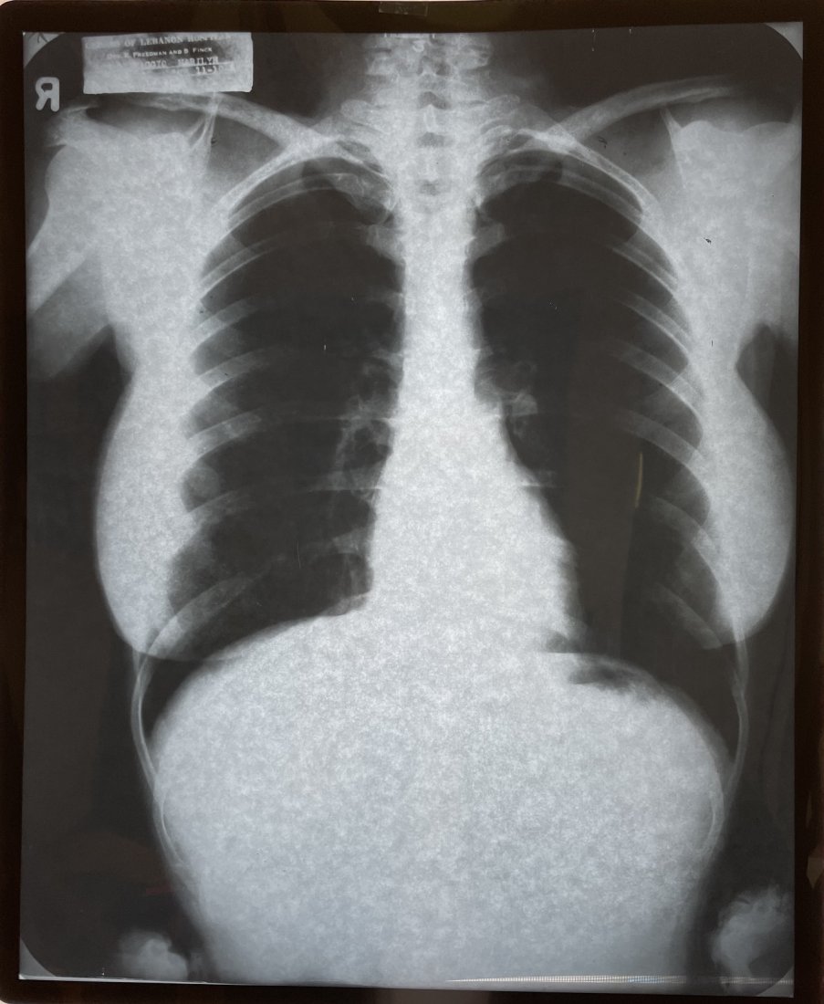Marilyn Monroe- X-Ray of her Chest (1 of 2)