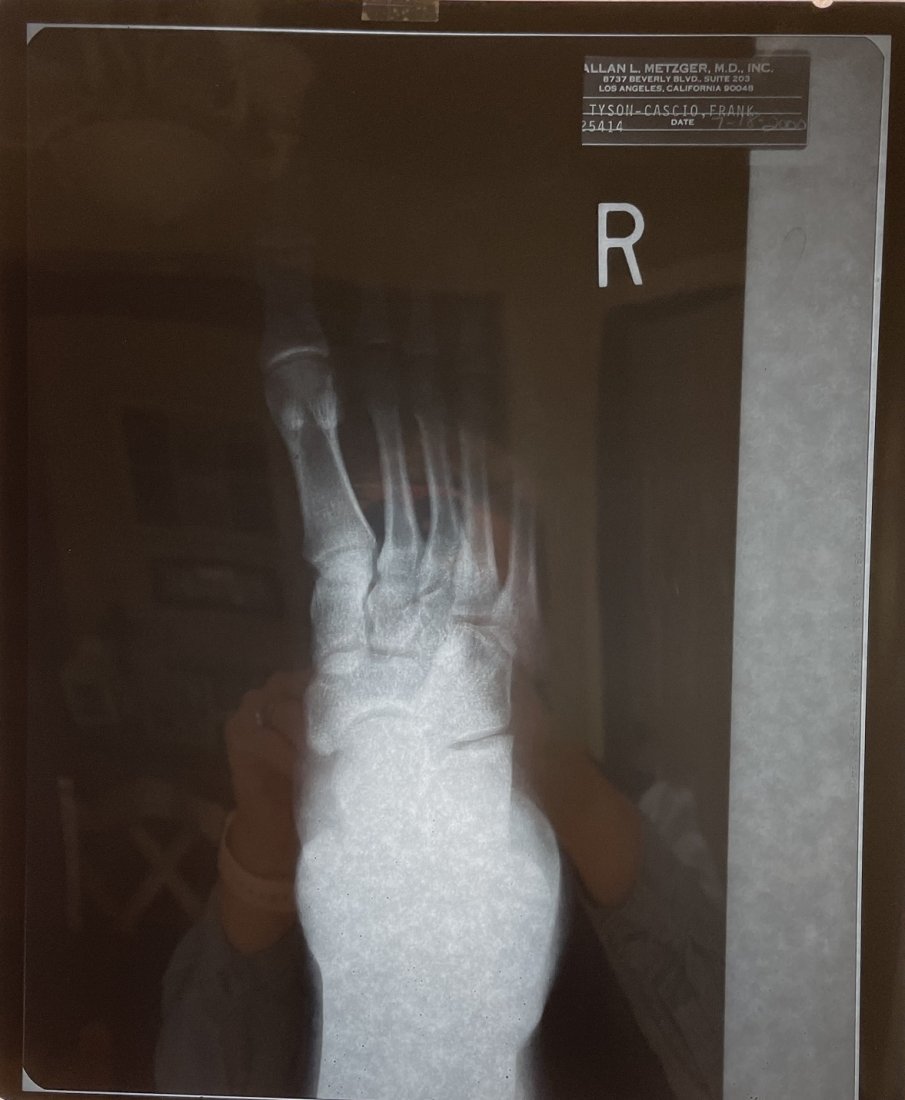 Michael Jackson- X-Ray of his Broken Foot: 10X12 RARE X-Ray of Michael Jackson's foot after breaking it at Neverland Ranch. The injury brought media attention. Michael would often times use fake names in public. This time on the X-Ray he used 