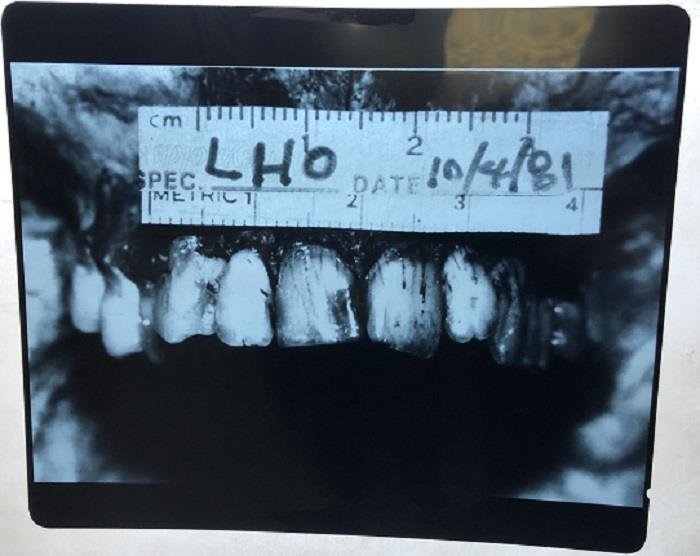 Lee Harvey Oswald- X-Ray of his Teeth when Exhumed: 12X10 X-Ray of Lee Harvey Oswald's teeth taken in 1981 when his body was exhumed. In very good condition. This is the same x-ray others are selling including Julien's auction house and others who are 