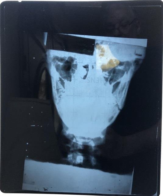 Muhammad Ali- X-Ray of his Broken Jaw from the Norton Fight: 10X12 X-Ray of Muhammad Ali's Broken Jaw. Muhammad Ali broke his jaw in his 1973 fight with Ken Norton. Norton handed Ali his second career defeat by winning a split decision. Very hard to find withou