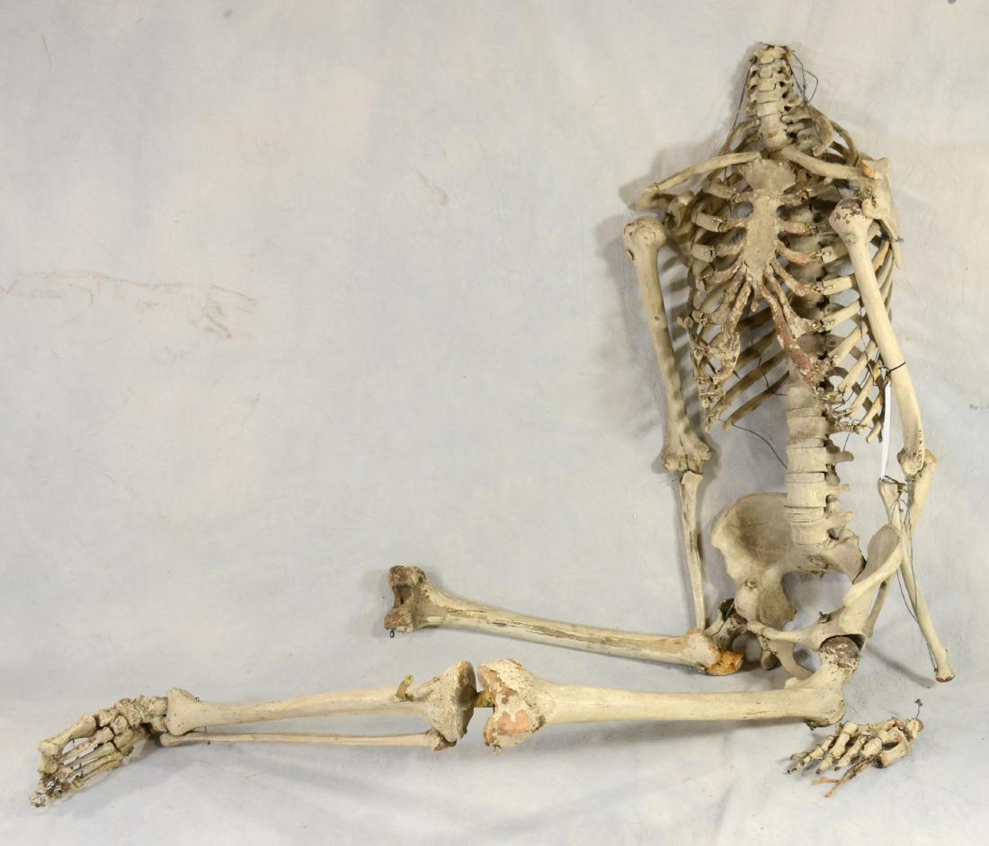 Genuine Partial Human Skeleton  Fully articulated (1 of 1)